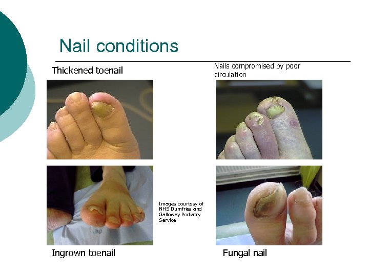 Nail conditions Nails compromised by poor circulation Thickened toenail Images courtesy of NHS Dumfries