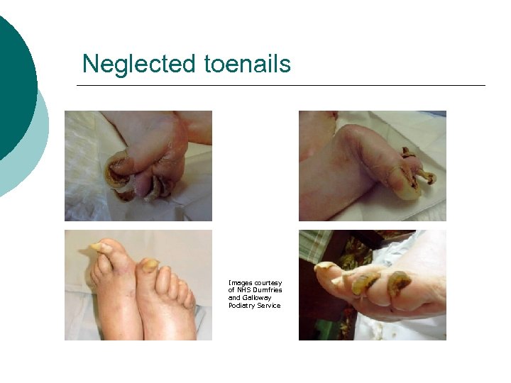 Neglected toenails Images courtesy of NHS Dumfries and Galloway Podiatry Service 