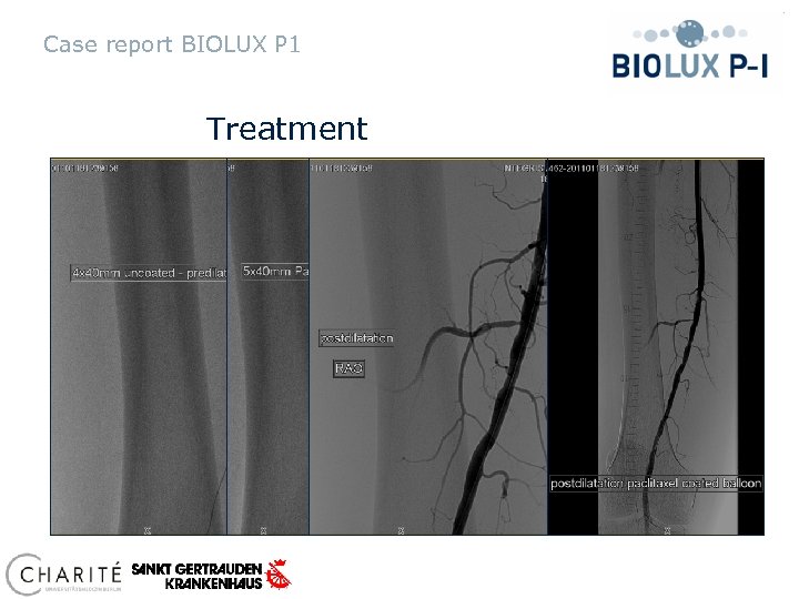 Case report BIOLUX P 1 Treatment 