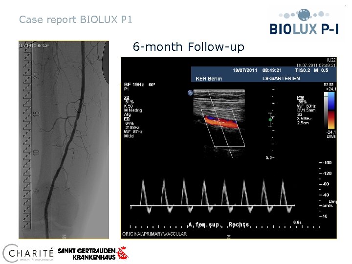 Case report BIOLUX P 1 6 -month Follow-up 