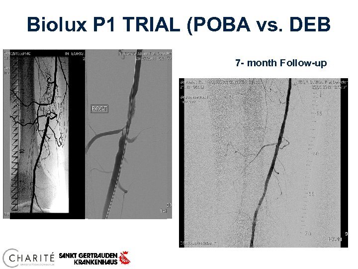 Biolux P 1 TRIAL (POBA vs. DEB 7 - month Follow-up 