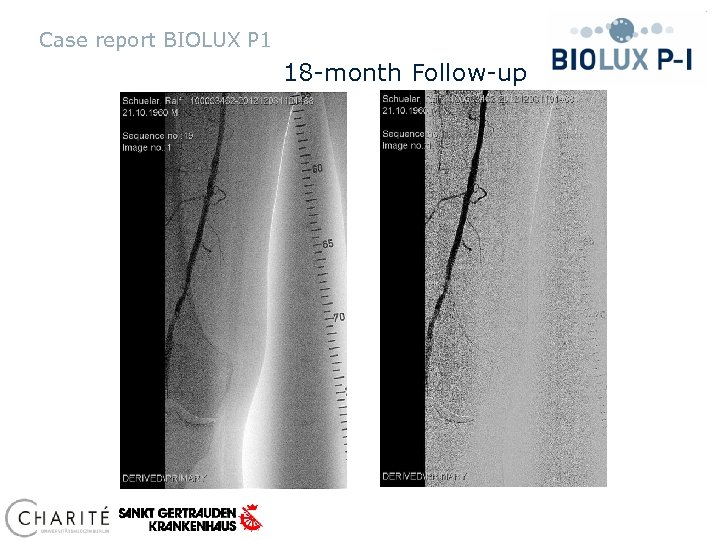 Case report BIOLUX P 1 18 -month Follow-up 