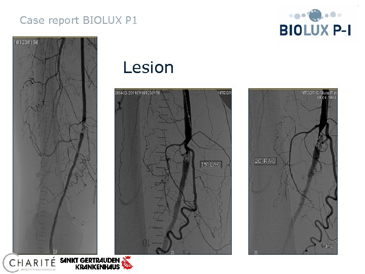 Case report BIOLUX P 1 Lesion 