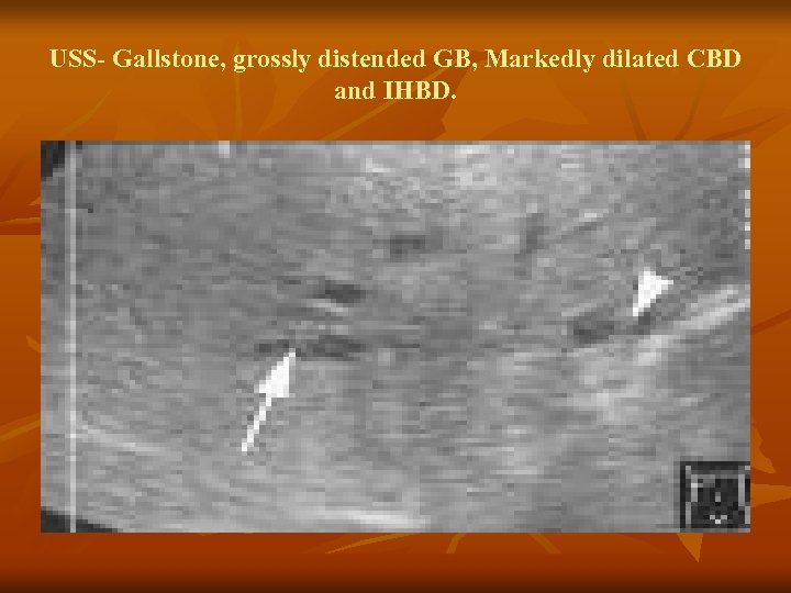USS- Gallstone, grossly distended GB, Markedly dilated CBD and IHBD. 