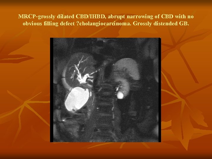 MRCP-grossly dilated CBD/IHBD, abrupt narrowing of CBD with no obvious filling defect ? cholangiocarcinoma.