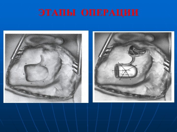 ЭТАПЫ ОПЕРАЦИИ 