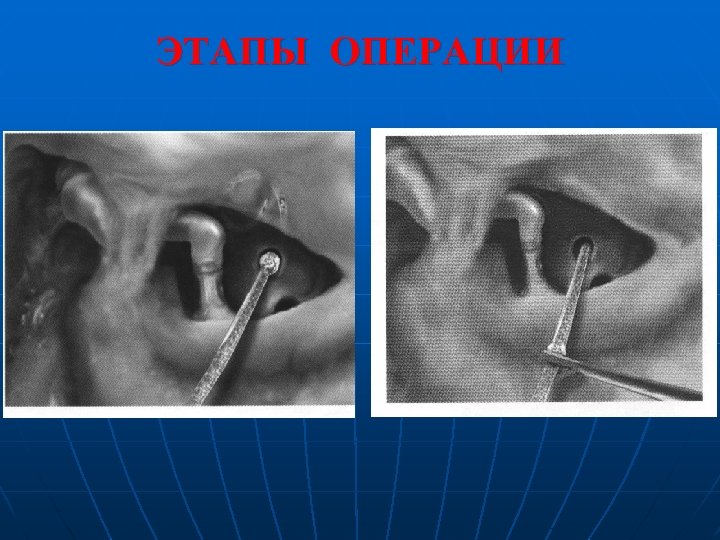ЭТАПЫ ОПЕРАЦИИ 