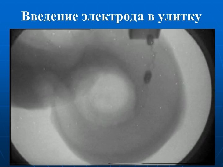 Введение электрода в улитку 