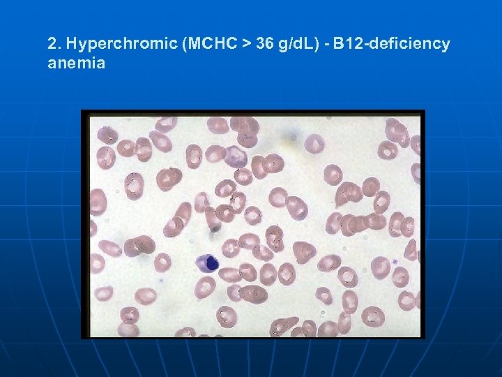2. Hyperchromic (MCHC > 36 g/d. L) - В 12 -deficiency anemia 