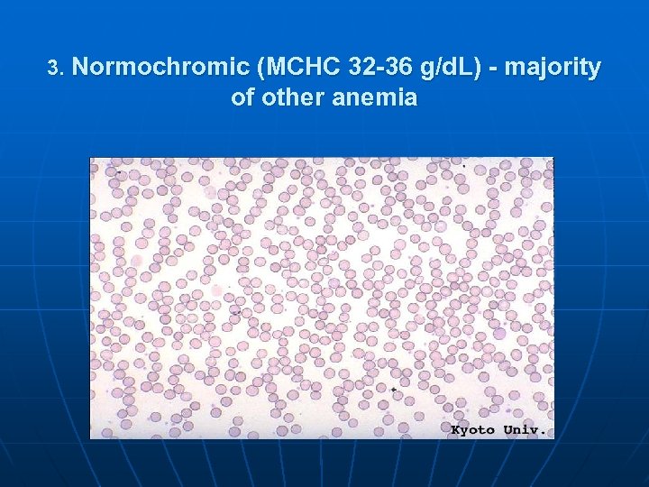 3. Normochromic (MCHC 32 -36 g/d. L) - majority of other anemia 