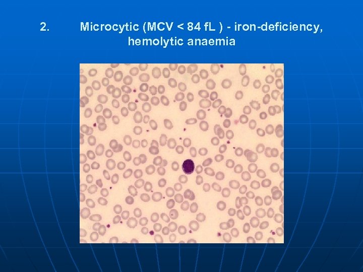 2. Microcytic (MCV < 84 f. L ) - iron-deficiency, hemolytic anaemia 