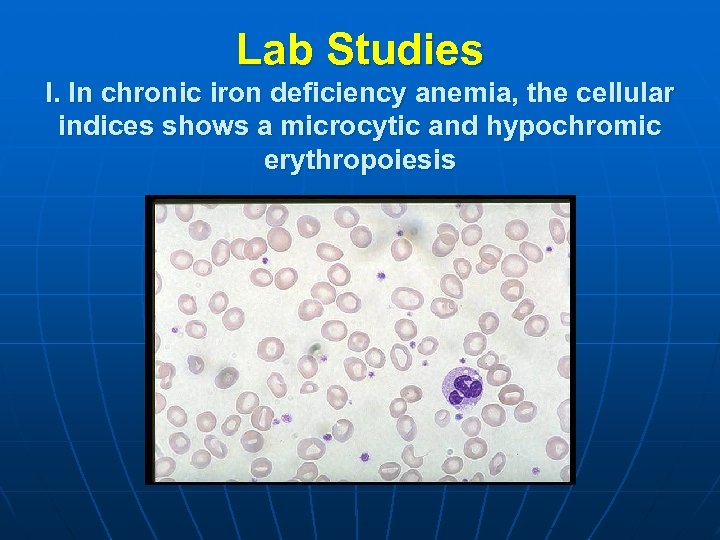 Lab Studies I. In chronic iron deficiency anemia, the cellular indices shows a microcytic