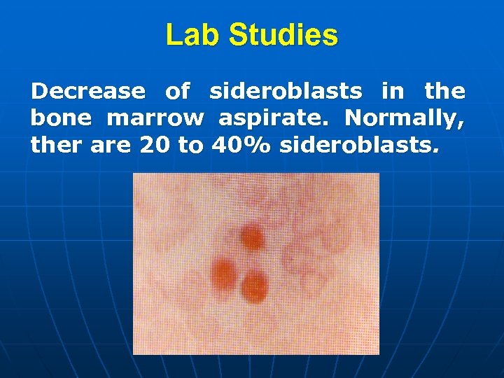 Lab Studies Decrease of sideroblasts in the bone marrow aspirate. Normally, ther are 20
