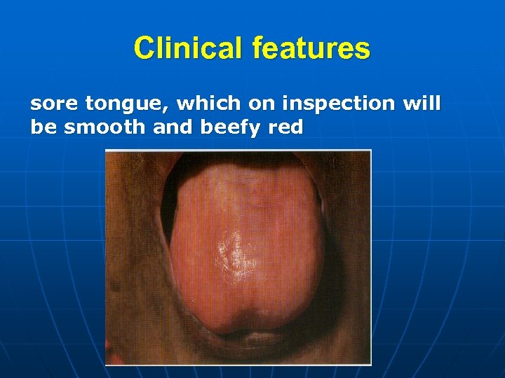Clinical features sore tongue, which on inspection will be smooth and beefy red 