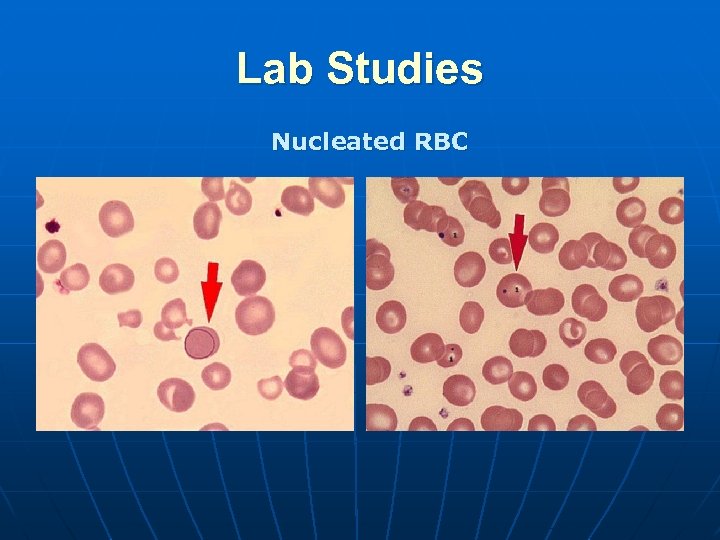 Lab Studies Nucleated RBC 