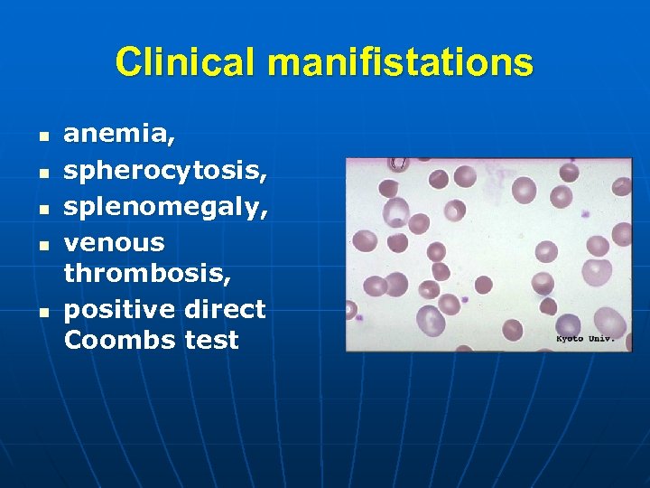 Clinical manifistations n n n anemia, spherocytosis, splenomegaly, venous thrombosis, positive direct Coombs test