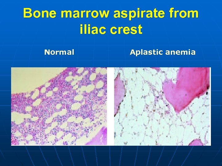Bone marrow aspirate from iliac crest Normal Aplastic anemia 