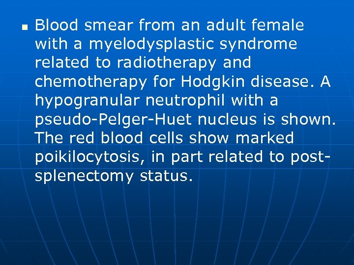 n Blood smear from an adult female with a myelodysplastic syndrome related to radiotherapy