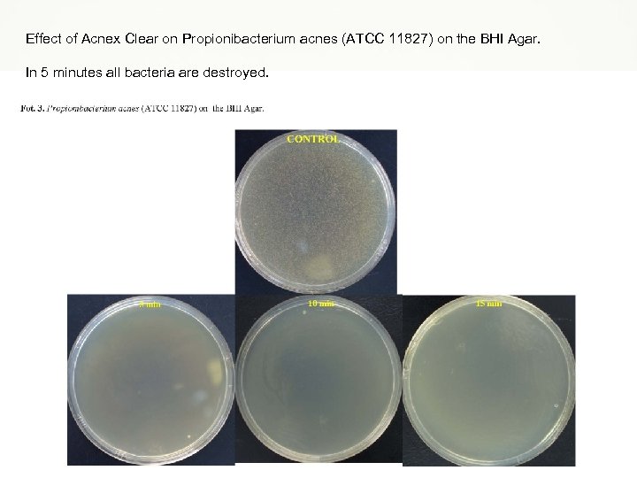 Effect of Acnex Clear on Propionibacterium acnes (ATCC 11827) on the BHI Agar. In