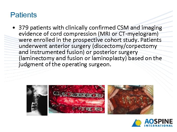 Patients • 379 patients with clinically confirmed CSM and imaging evidence of cord compression