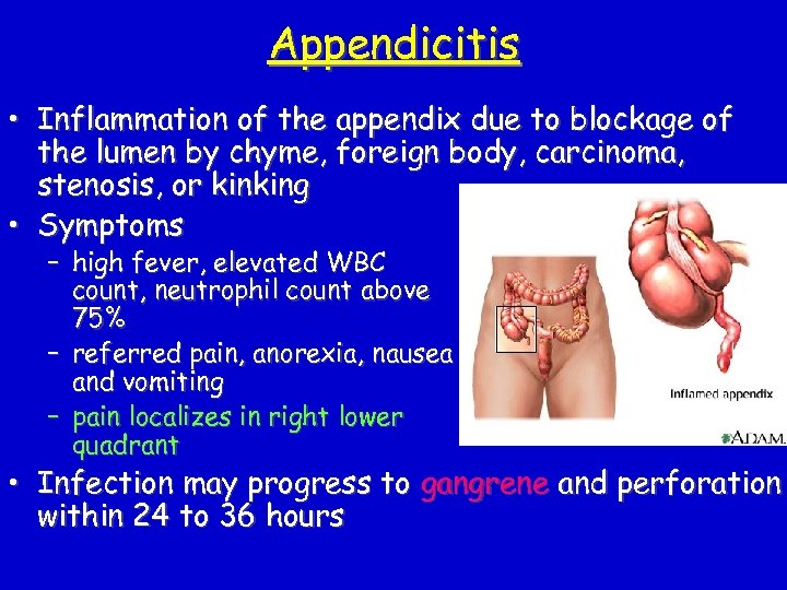 Appendicitis • Inflammation of the appendix due to blockage of the lumen by chyme,