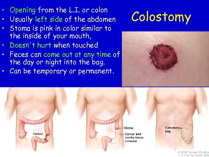  • Opening from the L. I. or colon • Usually left side of