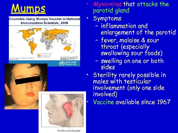 Mumps • Myxovirus that attacks the parotid gland • Symptoms – inflammation and enlargement