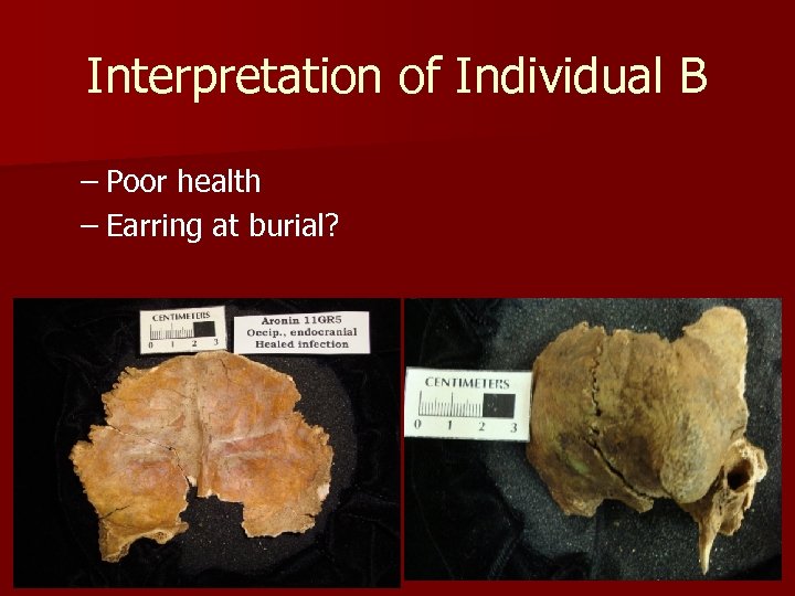 Interpretation of Individual B – Poor health – Earring at burial? 