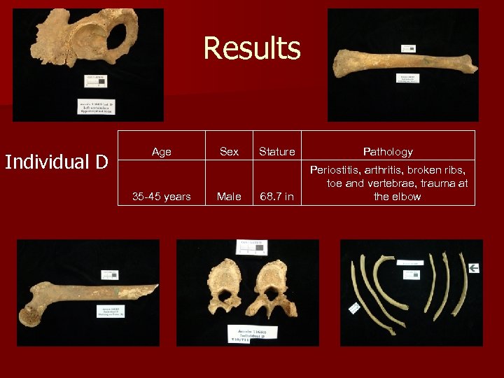 Results Individual D Age 35 -45 years Sex Male Stature Pathology 68. 7 in