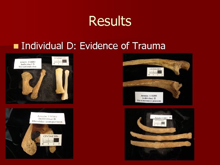 Results n Individual D: Evidence of Trauma 