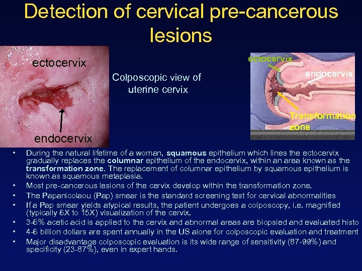 Detection of cervical pre-cancerous lesions ectocervix Colposcopic view of uterine cervix endocervix • •