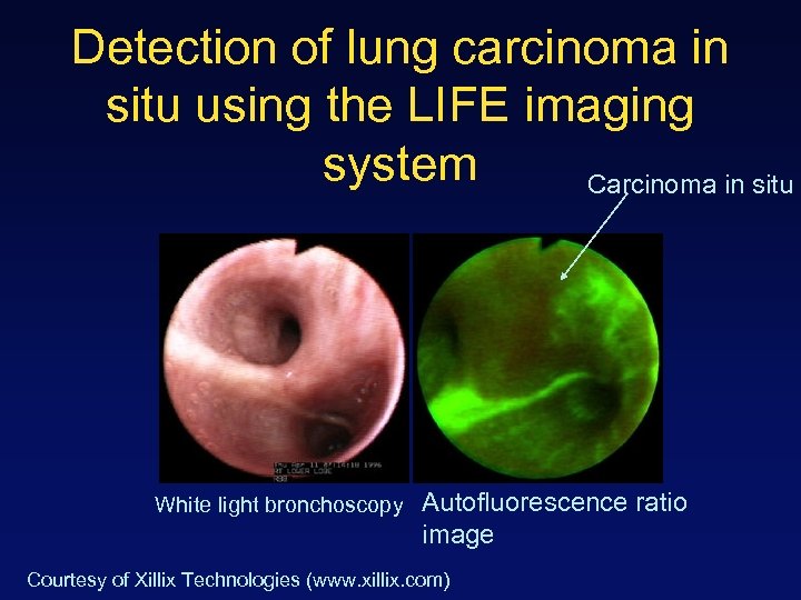 Detection of lung carcinoma in situ using the LIFE imaging system Carcinoma in situ