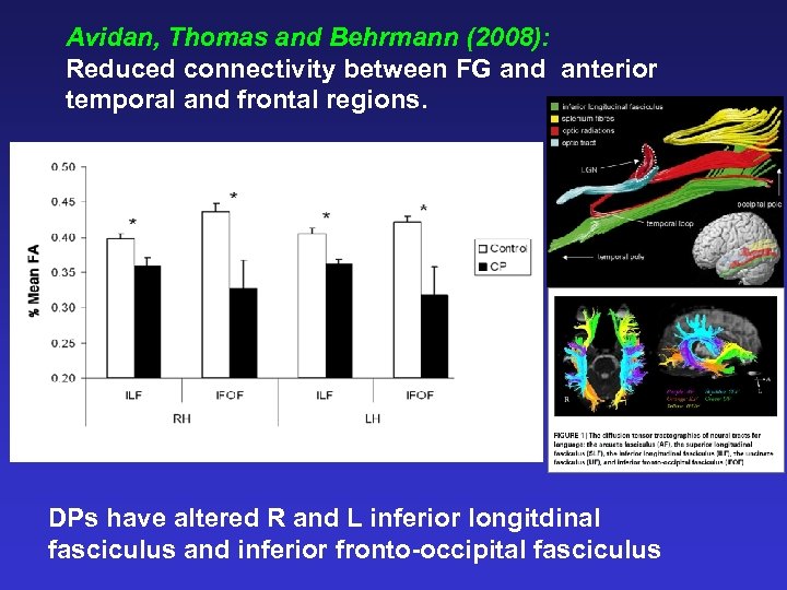 Avidan, Thomas and Behrmann (2008): Reduced connectivity between FG and anterior temporal and frontal