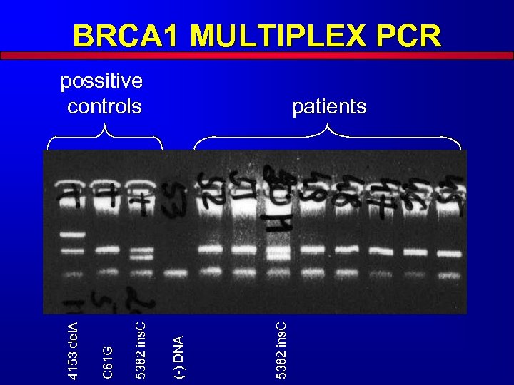 BRCA 1 MULTIPLEX PCR 5382 ins. C patients (-) DNA 5382 ins. C C