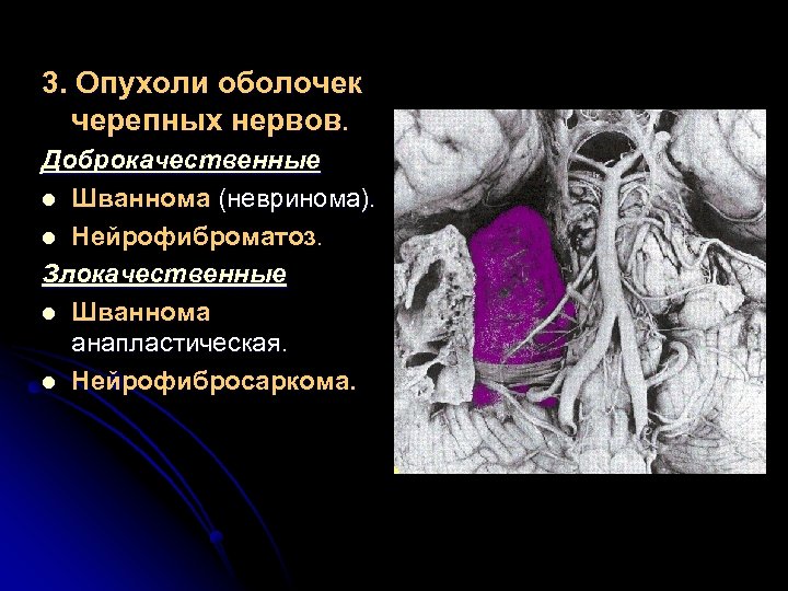 3. Опухоли оболочек черепных нервов. Доброкачественные l Шваннома (невринома). l Нейрофиброматоз. Злокачественные l Шваннома