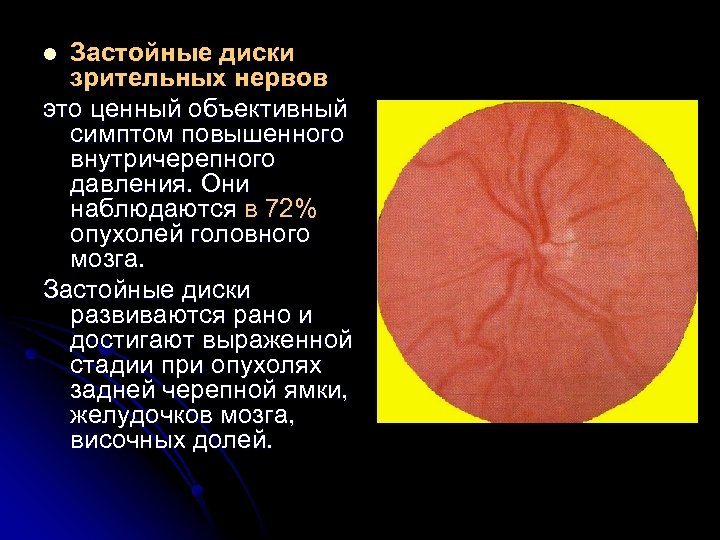 Застойные диски зрительных нервов это ценный объективный симптом повышенного внутричерепного давления. Они наблюдаются в