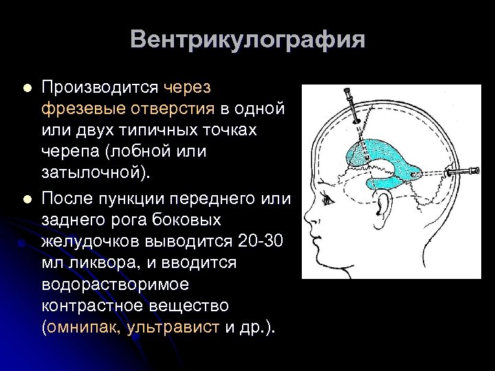 Вентрикулография l l Производится через фрезевые отверстия в одной или двух типичных точках черепа