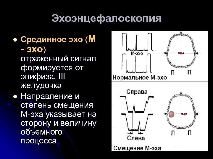 Эхоэнцефалоскопия l l Срединное эхо (М - эхо) – отраженный сигнал формируется от эпифиза,