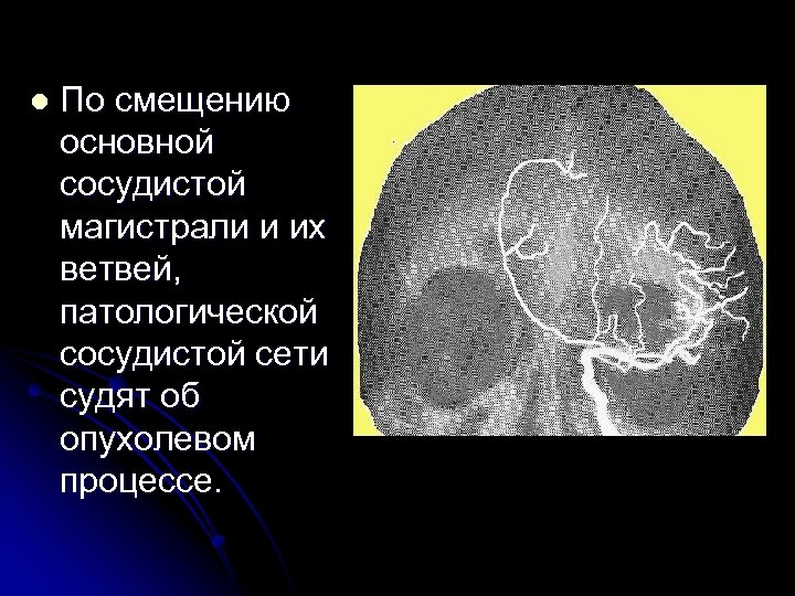 l По смещению основной сосудистой магистрали и их ветвей, патологической сосудистой сети судят об