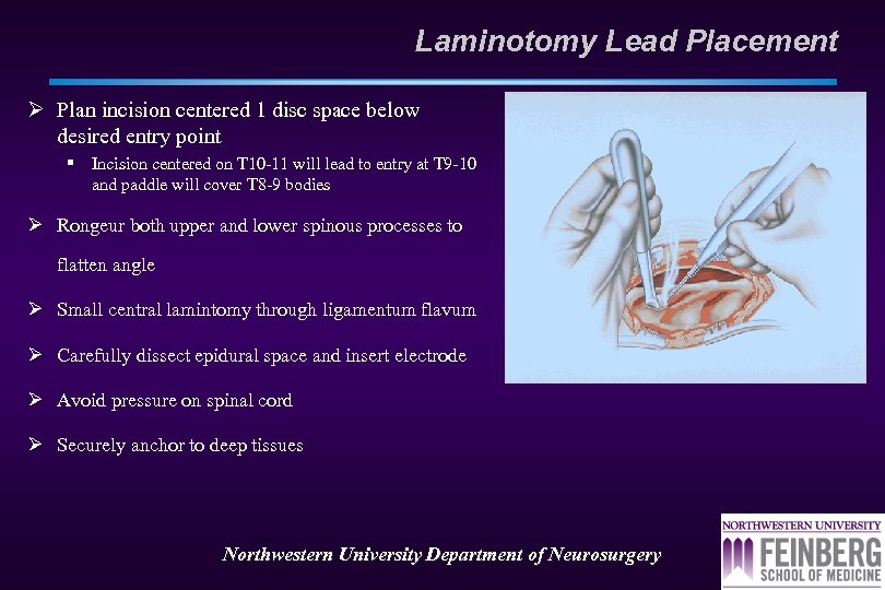Laminotomy Lead Placement Ø Plan incision centered 1 disc space below desired entry point