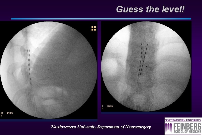 Guess the level! Northwestern University Department of Neurosurgery 