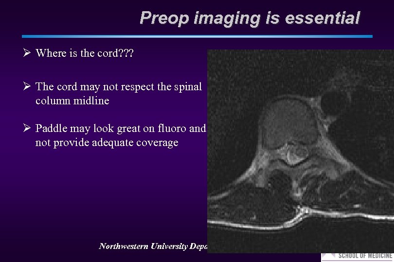 Preop imaging is essential Ø Where is the cord? ? ? Ø The cord