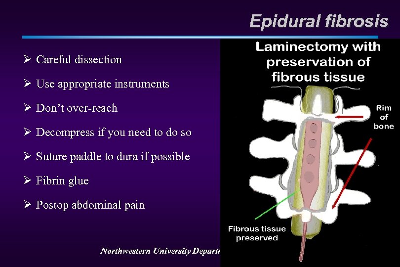 Epidural fibrosis Ø Careful dissection Ø Use appropriate instruments Ø Don’t over-reach Ø Decompress
