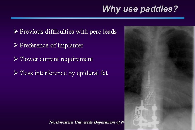 Why use paddles? Ø Previous difficulties with perc leads Ø Preference of implanter Ø