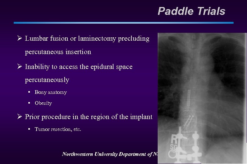 Paddle Trials Ø Lumbar fusion or laminectomy precluding percutaneous insertion Ø Inability to access