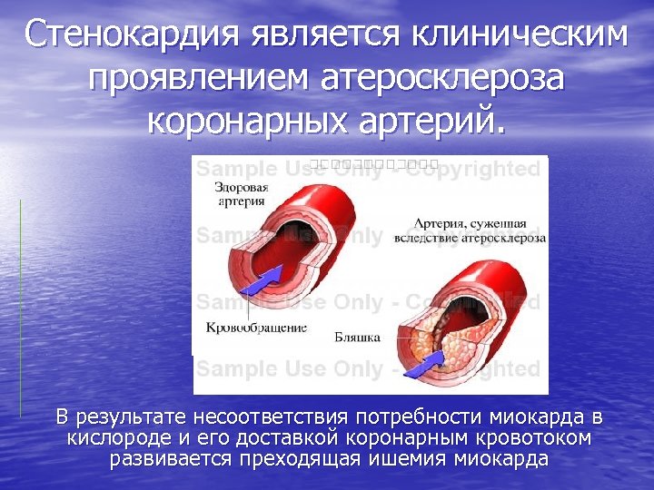 Стенокардия является клиническим проявлением атеросклероза коронарных артерий. В результате несоответствия потребности миокарда в кислороде