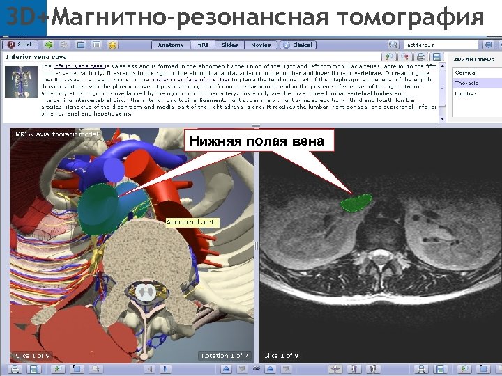 3 D+Магнитно-резонансная томография Нижняя полая Полая нижняя вена 