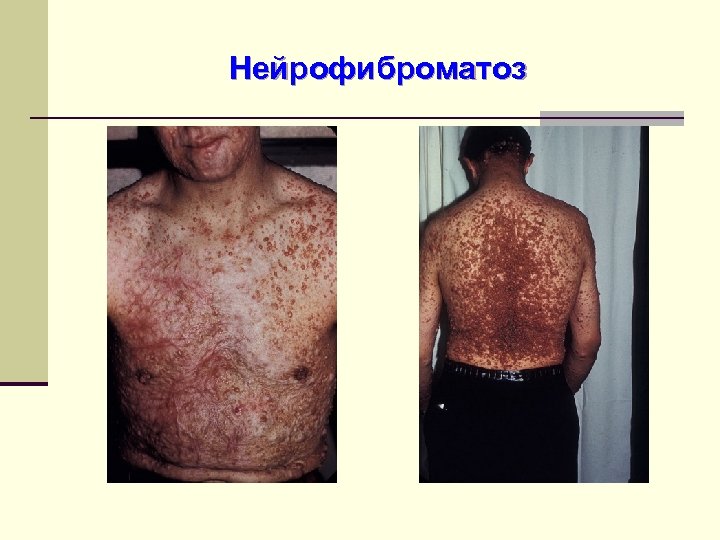 Нейрофиброматоз 