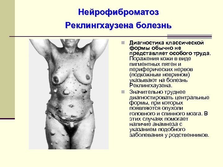 Нейрофиброматоз Реклингхаузена болезнь n Диагностика классической формы обычно не представляет особого труда. Поражения кожи