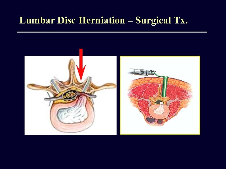 Lumbar Disc Herniation – Surgical Tx. 